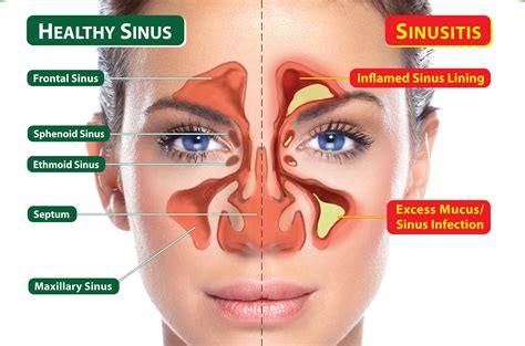 Understanding Sinusitis: Symptoms, Treatment, and COVID-19 Overlap