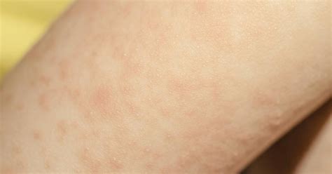 Understanding Skin Rashes: Causes, Symptoms, and Treatment Options