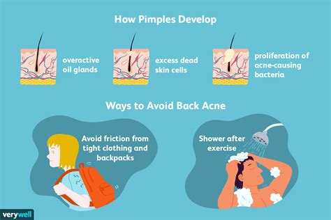 Understanding the Causes of Adult Acne and Effective Treatment Methods