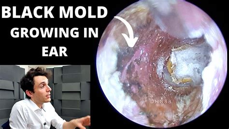 Is Mold Exposure a Health Risk? Insights from Ohio State Health, NC State Extension, and Harvard Health