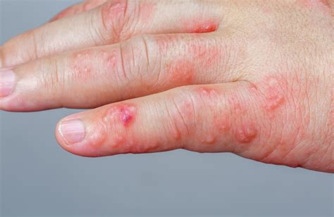 Understanding Blisters: Causes, Symptoms, and Treatment Options