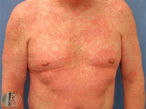 Understanding Drug Rashes: More Than Just a Skin Issue?