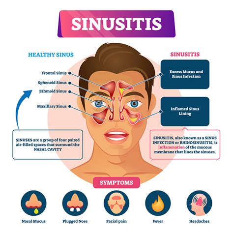 Understanding Sinusitis: Symptoms, Causes, and Treatment Options