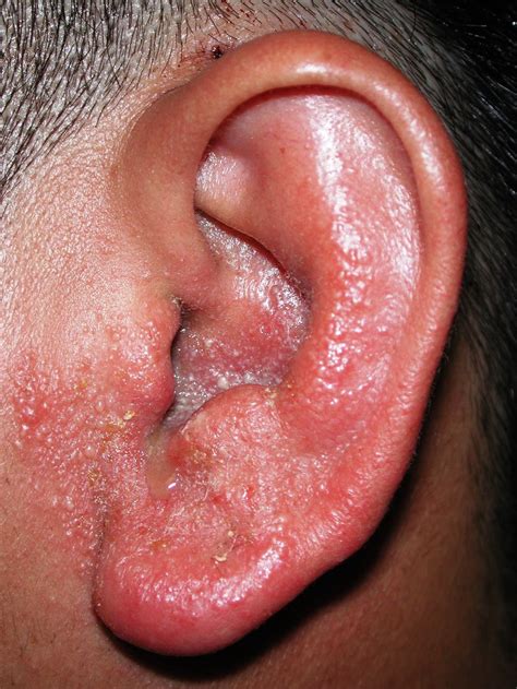 Understanding Middle Ear Infections: Causes, Symptoms, and Prevention