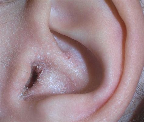 Understanding the Connection Between Ear Infections and Hives: Insights from Health Experts