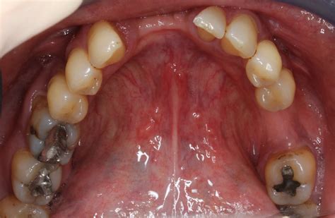 Understanding the Connection Between Sinusitis and Dental Infections